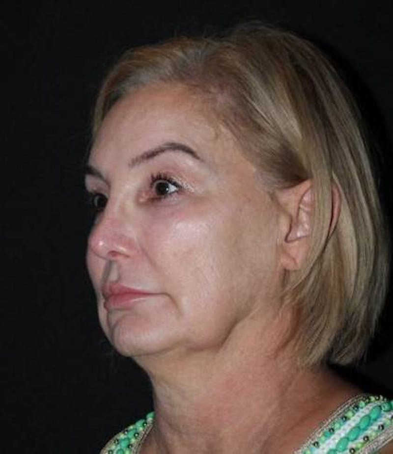 Facelift Before & After Gallery - Patient 298697 - Image 3