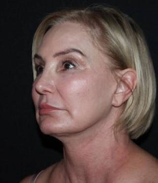 Facelift Before & After Gallery - Patient 298697 - Image 4