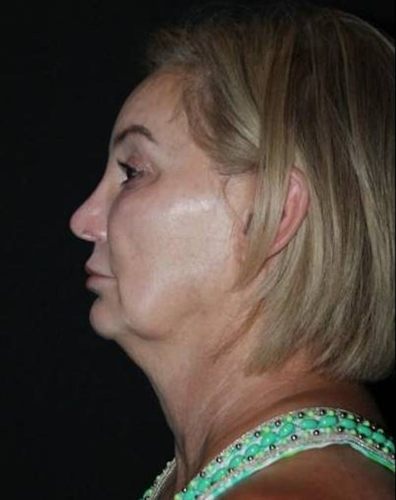 Facelift Before & After Gallery - Patient 298697 - Image 5
