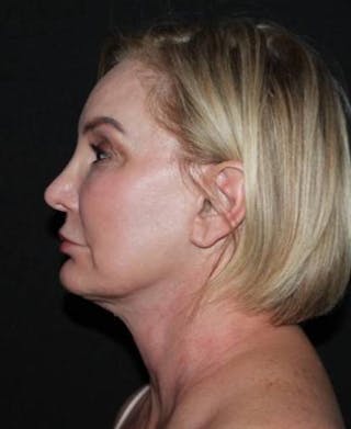 Facelift Before & After Gallery - Patient 298697 - Image 6