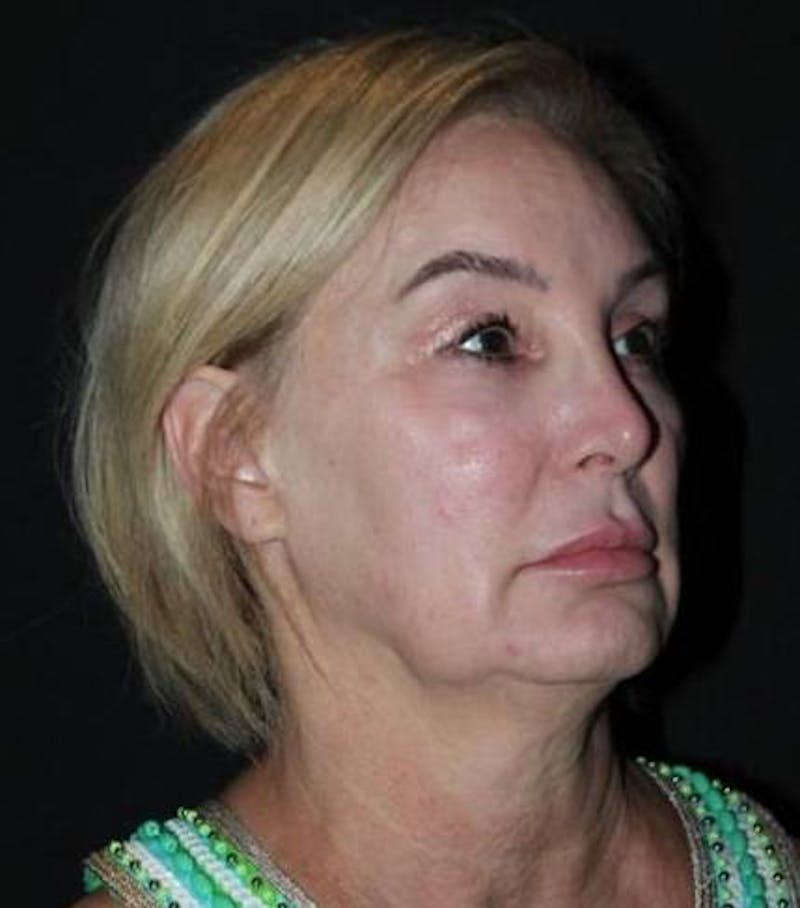 Facelift Before & After Gallery - Patient 298697 - Image 7