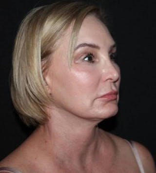 Facelift Before & After Gallery - Patient 298697 - Image 8