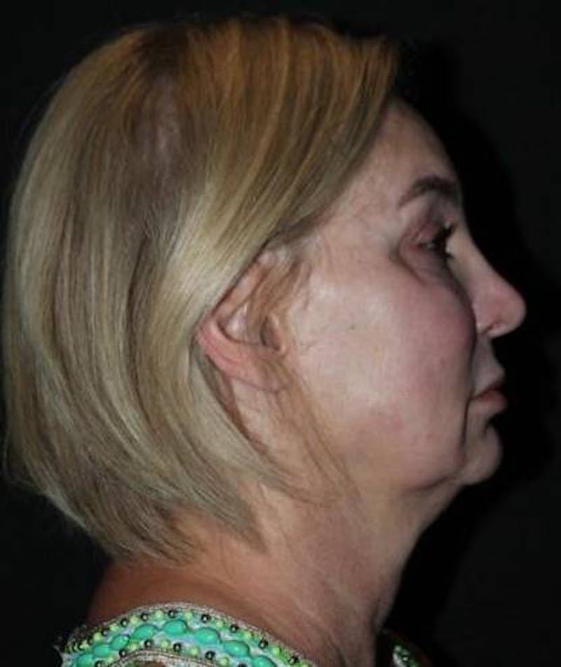 Facelift Before & After Gallery - Patient 298697 - Image 9