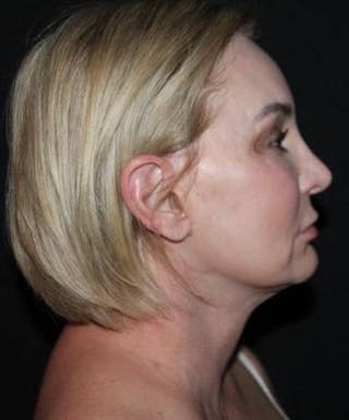 Facelift Before & After Gallery - Patient 298697 - Image 10
