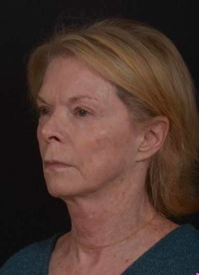 Facelift Before & After Gallery - Patient 159447 - Image 3