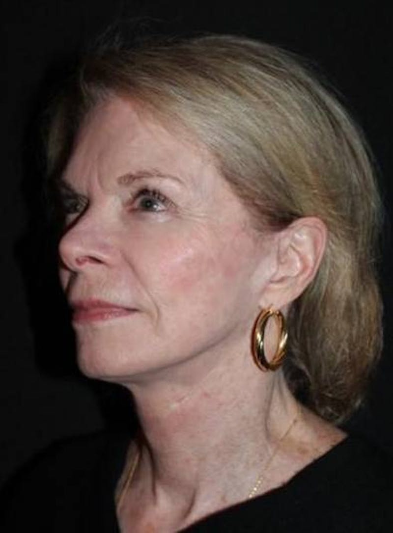 Facelift Before & After Gallery - Patient 159447 - Image 4