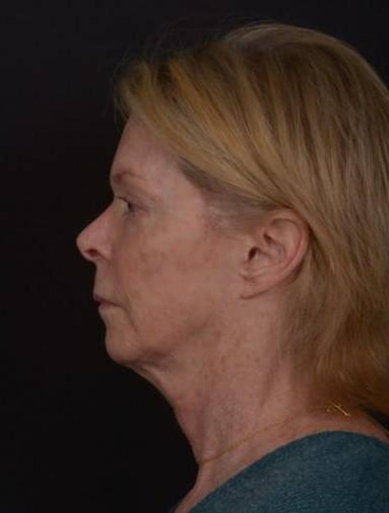 Facelift Before & After Gallery - Patient 159447 - Image 5