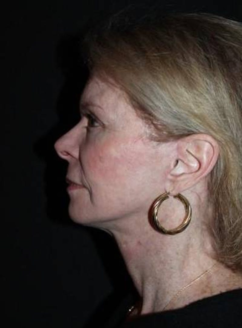 Facelift Before & After Gallery - Patient 159447 - Image 6