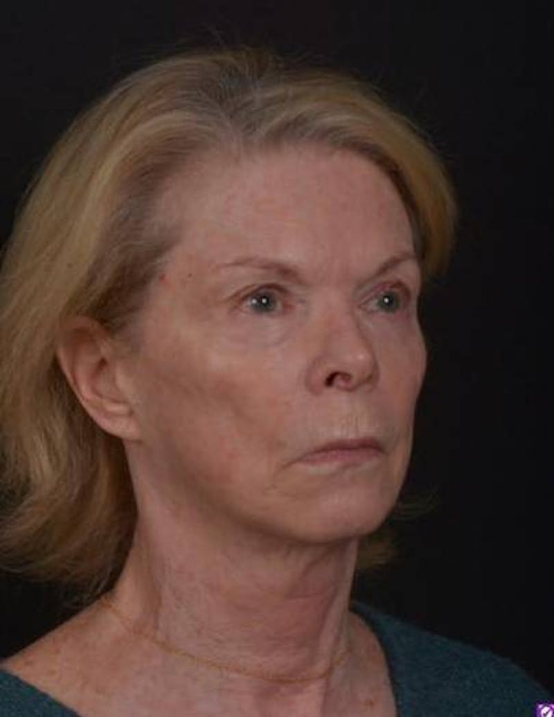 Facelift Before & After Gallery - Patient 159447 - Image 7