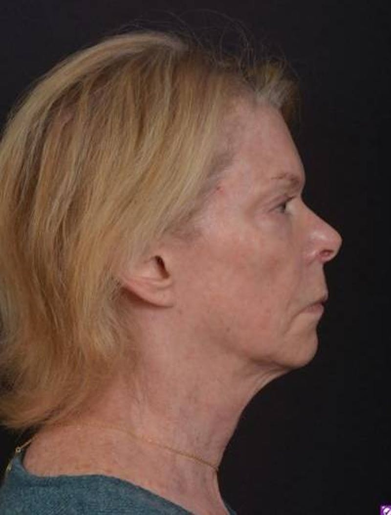 Facelift Before & After Gallery - Patient 159447 - Image 9