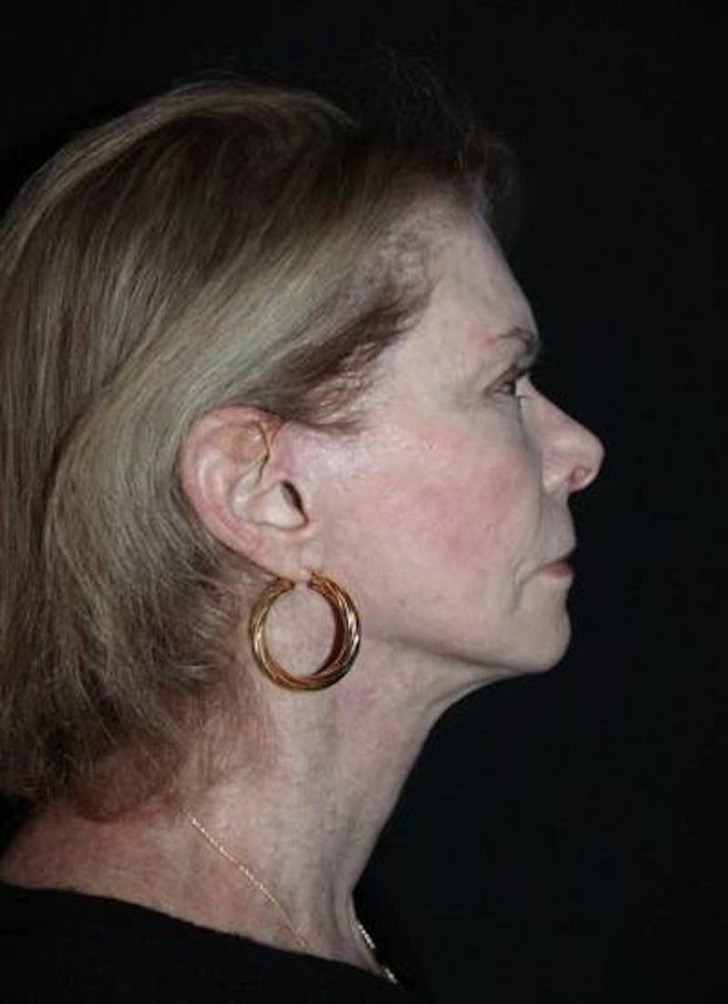 Facelift Before & After Gallery - Patient 159447 - Image 10