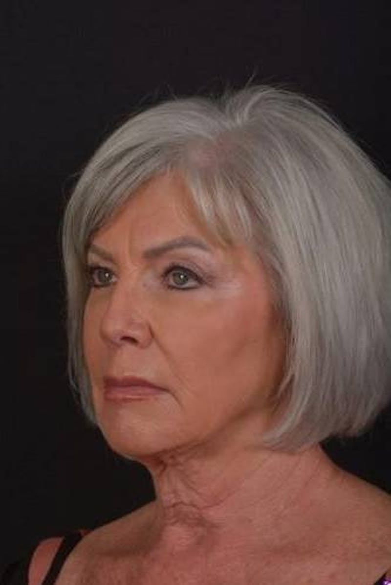 Facelift Before & After Gallery - Patient 152126 - Image 3
