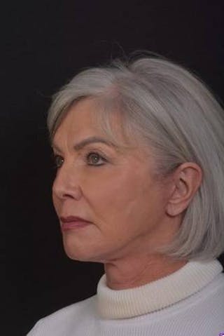 Facelift Before & After Gallery - Patient 152126 - Image 4