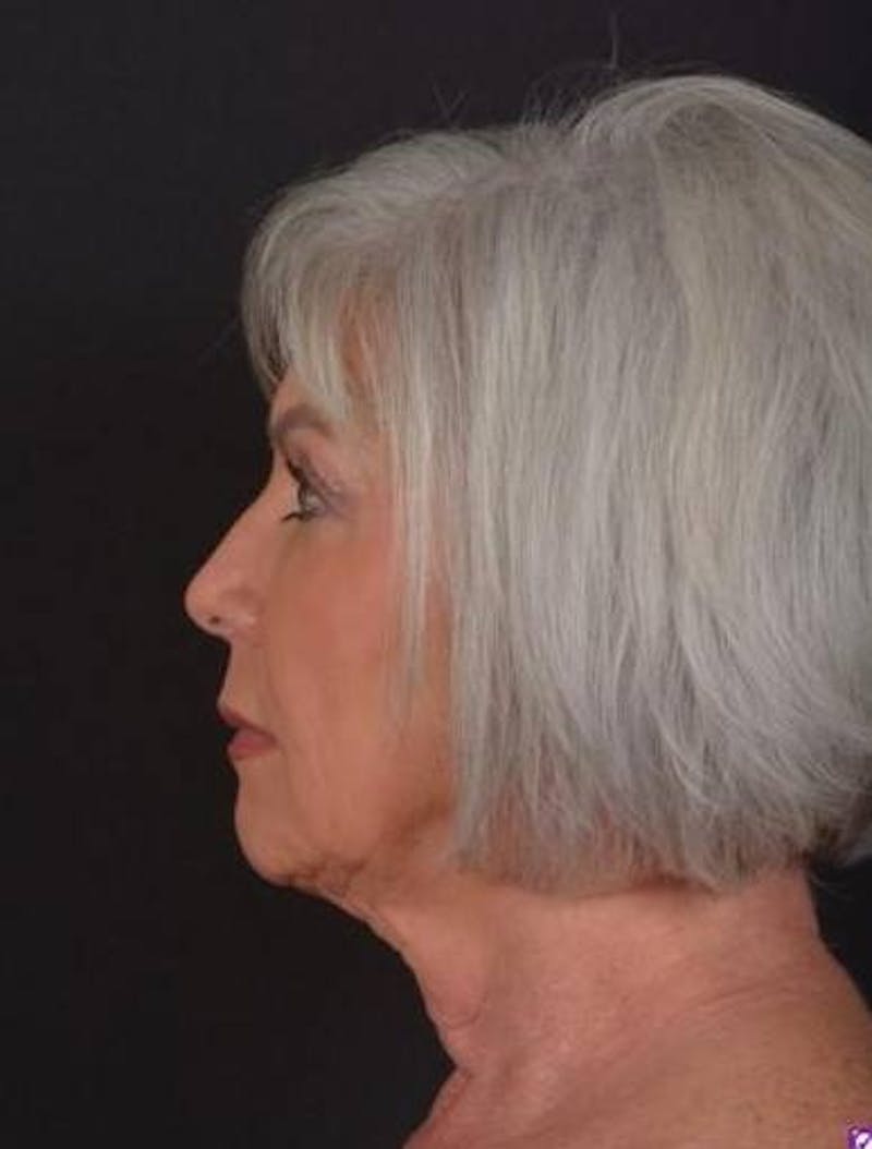 Facelift Before & After Gallery - Patient 152126 - Image 5