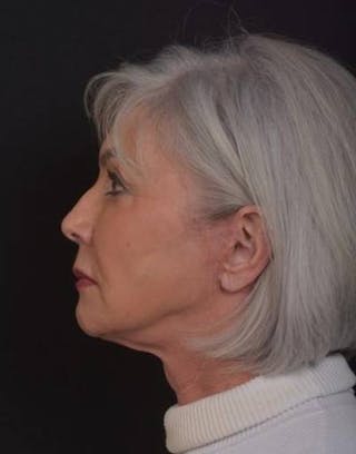Facelift Before & After Gallery - Patient 152126 - Image 6