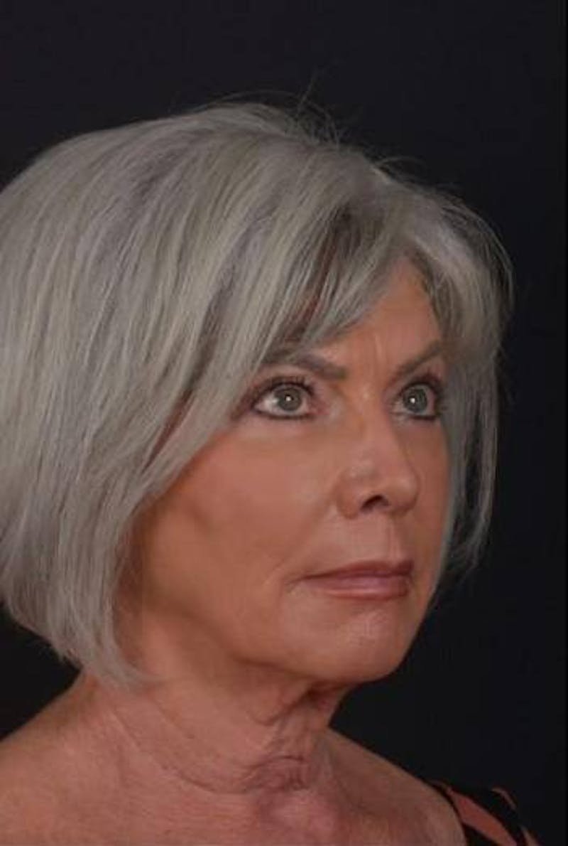 Facelift Before & After Gallery - Patient 152126 - Image 7
