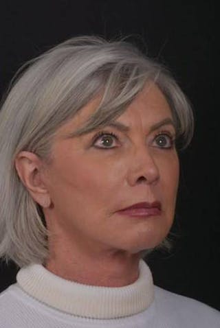 Facelift Before & After Gallery - Patient 152126 - Image 8