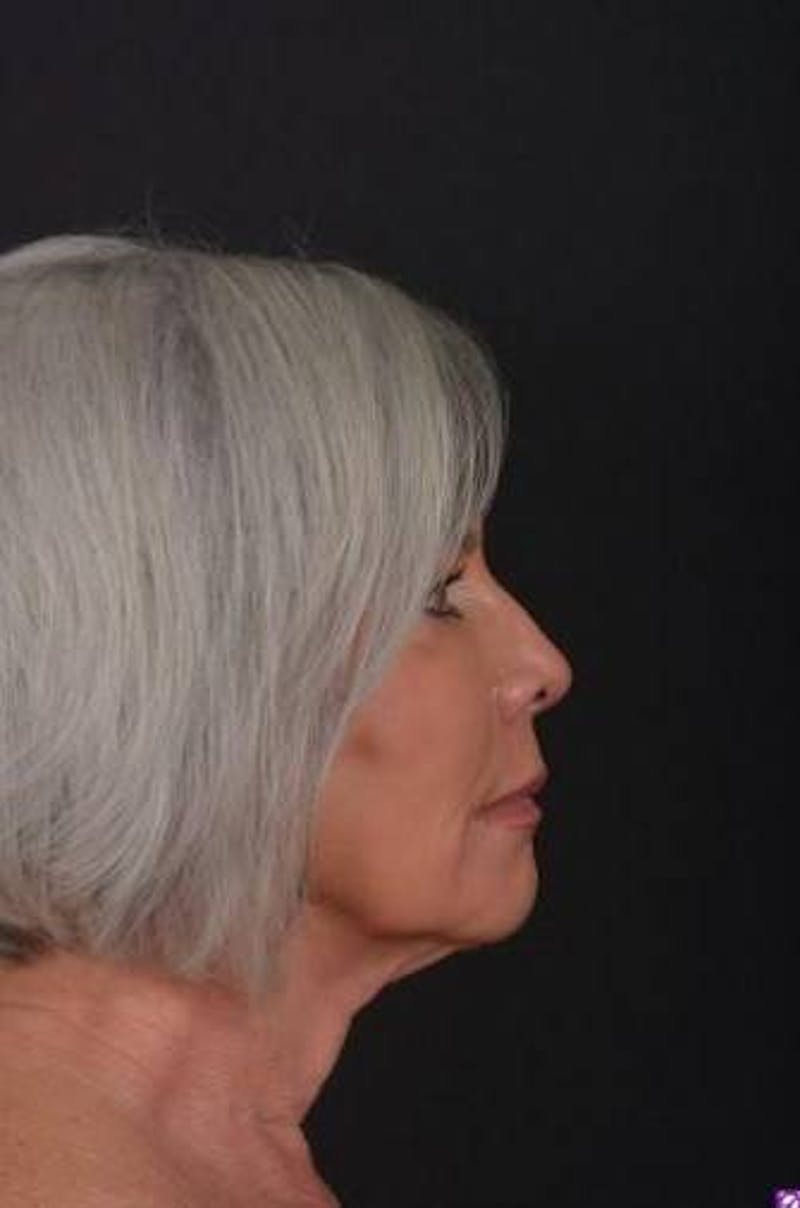 Facelift Before & After Gallery - Patient 152126 - Image 9