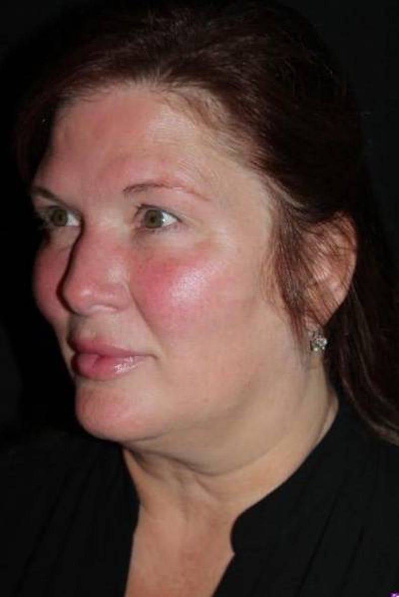 Facelift Before & After Gallery - Patient 165652 - Image 3