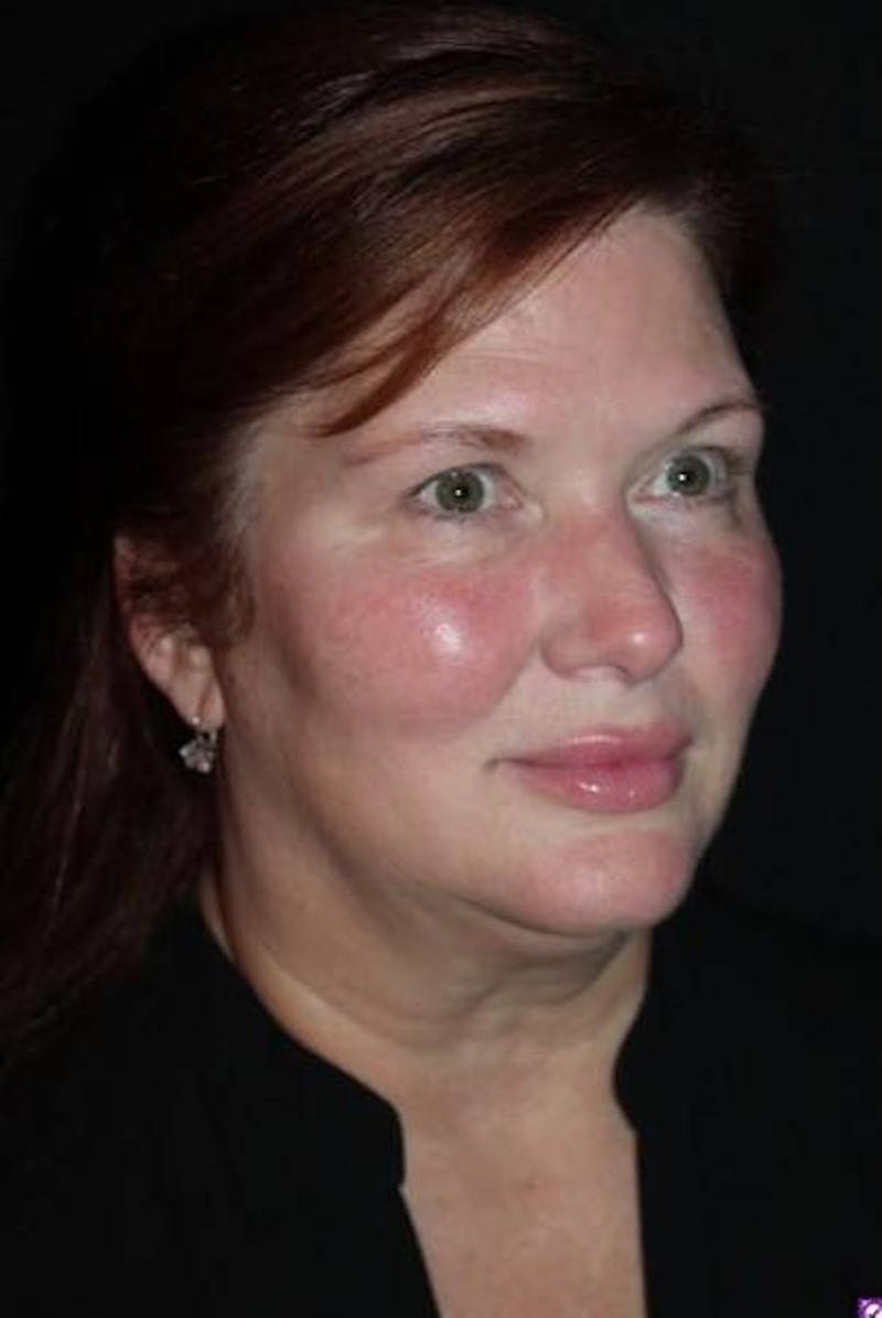 Facelift Before & After Gallery - Patient 165652 - Image 7