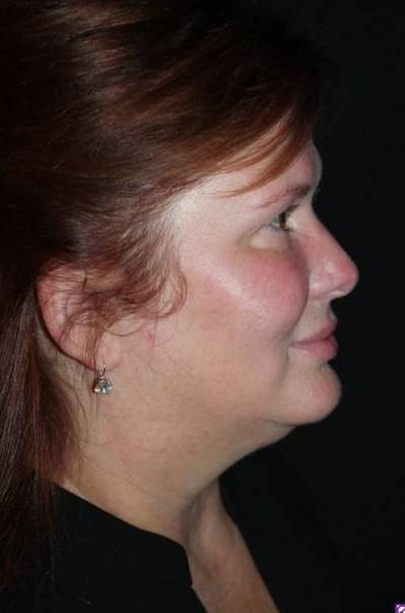 Facelift Before & After Gallery - Patient 165652 - Image 9