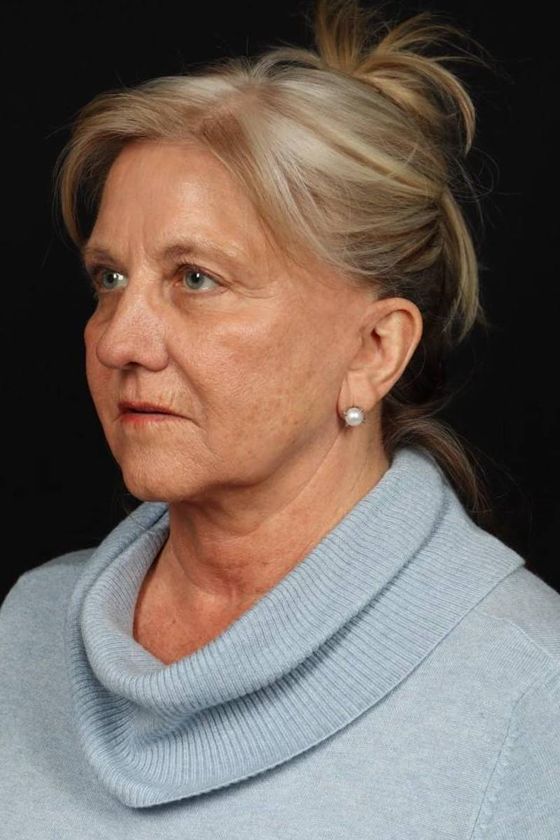 Facelift Before & After Gallery - Patient 403091 - Image 3