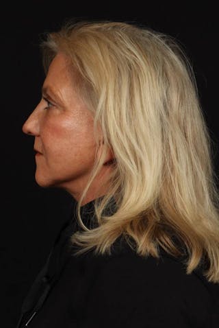 Facelift Before & After Gallery - Patient 403091 - Image 6