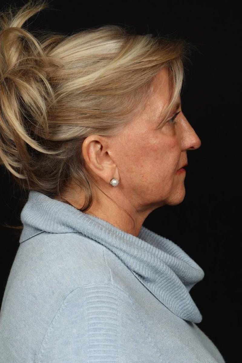 Facelift Before & After Gallery - Patient 403091 - Image 9