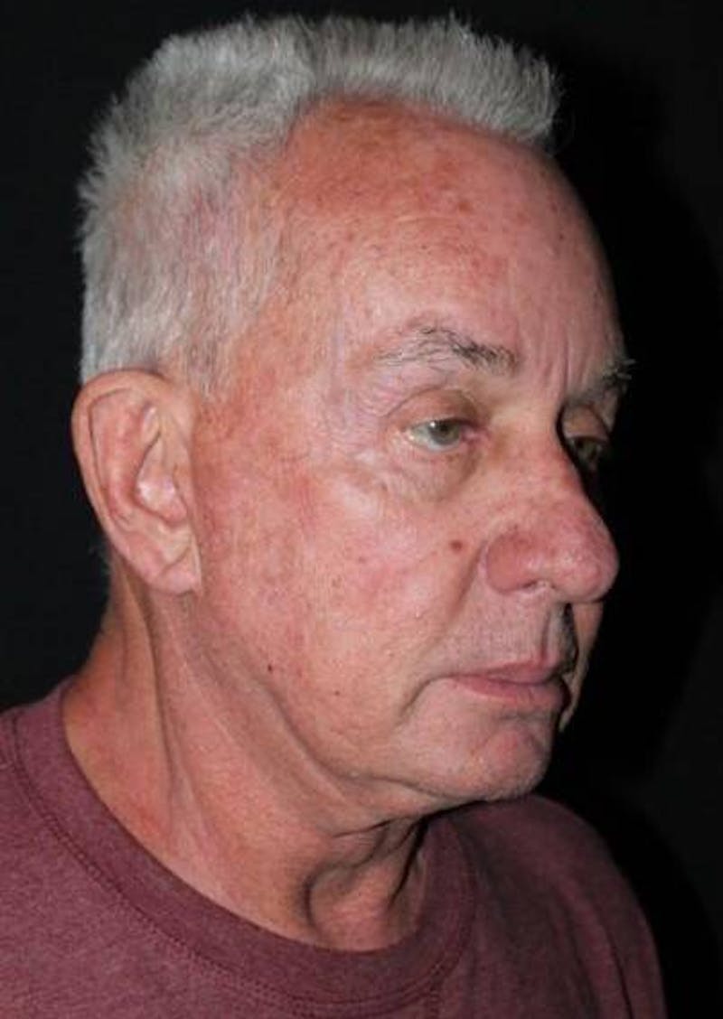 Facelift Before & After Gallery - Patient 301460 - Image 7