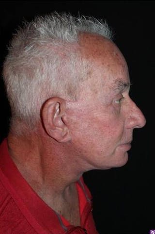 Facelift Before & After Gallery - Patient 301460 - Image 10