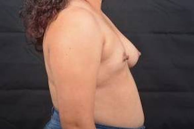 Breast Asymmetry Correction Before & After Gallery - Patient 386743 - Image 5