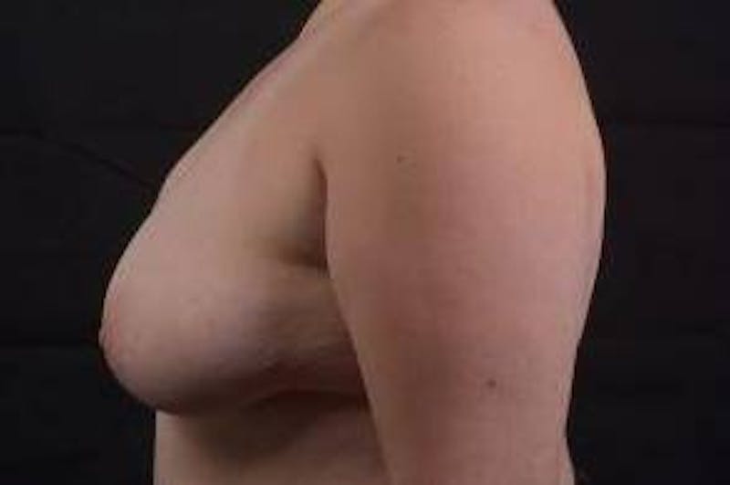 Breast Asymmetry Correction Before & After Gallery - Patient 316402 - Image 3