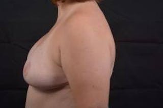 Breast Asymmetry Correction Before & After Gallery - Patient 316402 - Image 4