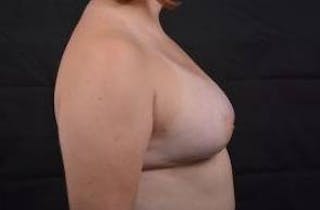 Breast Asymmetry Correction Before & After Gallery - Patient 316402 - Image 6