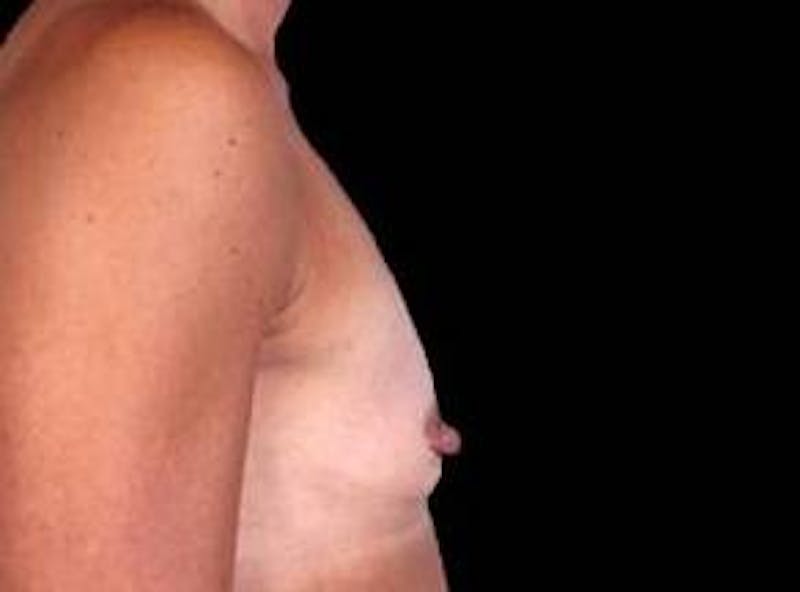 Breast Augmentation 410 Before & After Gallery - Patient 398706 - Image 3