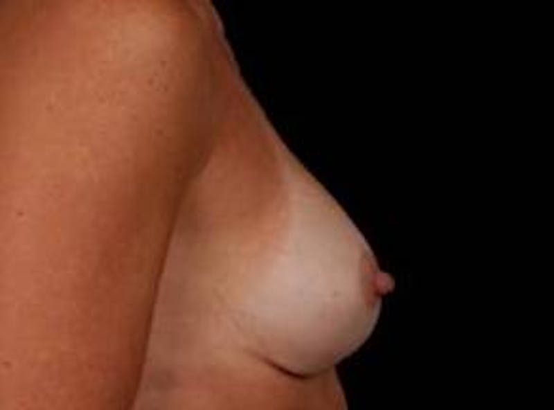 Breast Augmentation 410 Before & After Gallery - Patient 398706 - Image 4