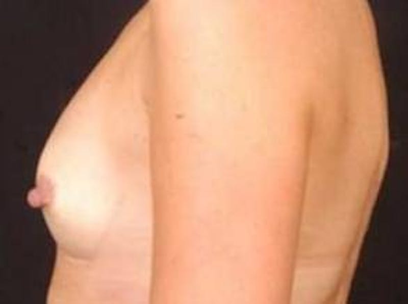 Breast Augmentation 410 Before & After Gallery - Patient 864956 - Image 3