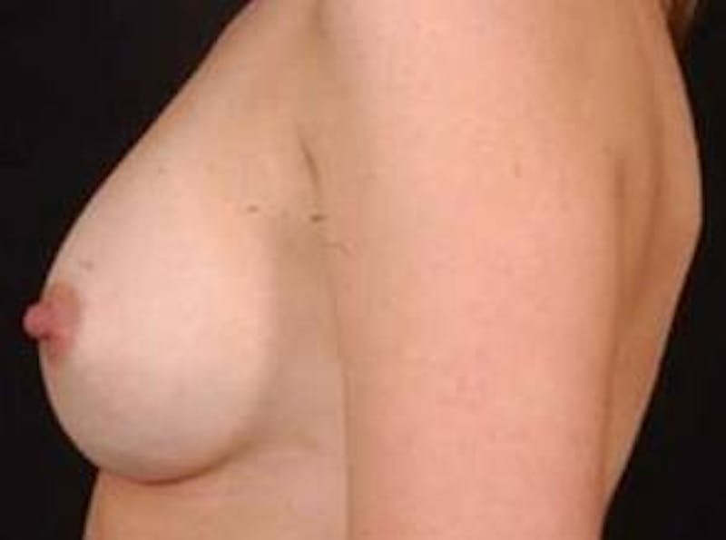 Breast Augmentation 410 Before & After Gallery - Patient 864956 - Image 4