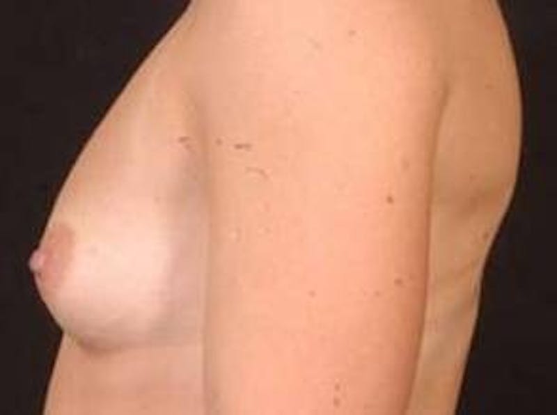 Breast Asymmetry Correction Before & After Gallery - Patient 340799 - Image 7