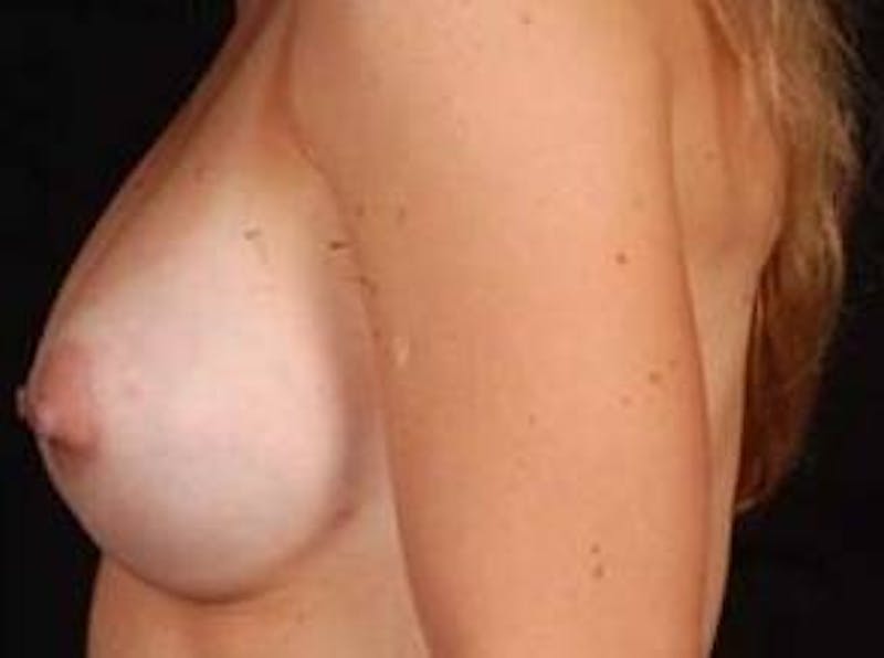 Breast Asymmetry Correction Before & After Gallery - Patient 340799 - Image 8