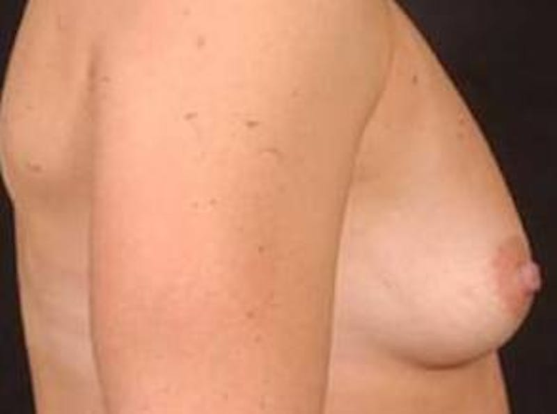 Breast Asymmetry Correction Before & After Gallery - Patient 340799 - Image 9
