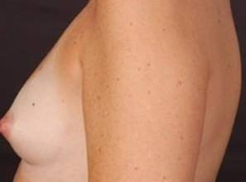 Breast Augmentation 410 Before & After Gallery - Patient 281973 - Image 3