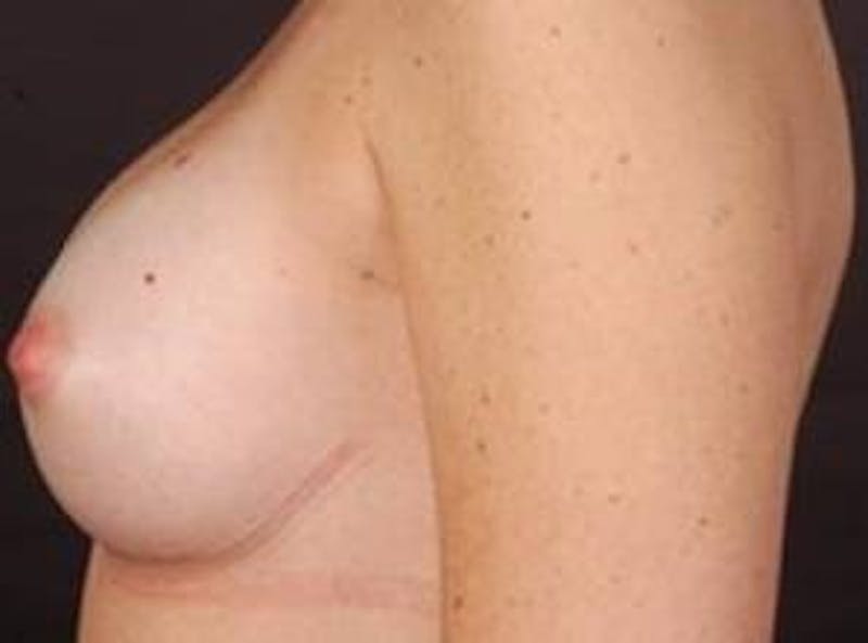 Breast Augmentation 410 Before & After Gallery - Patient 281973 - Image 4