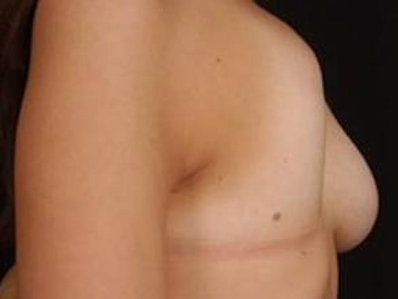 Breast Asymmetry Correction Before & After Gallery - Patient 185545 - Image 5