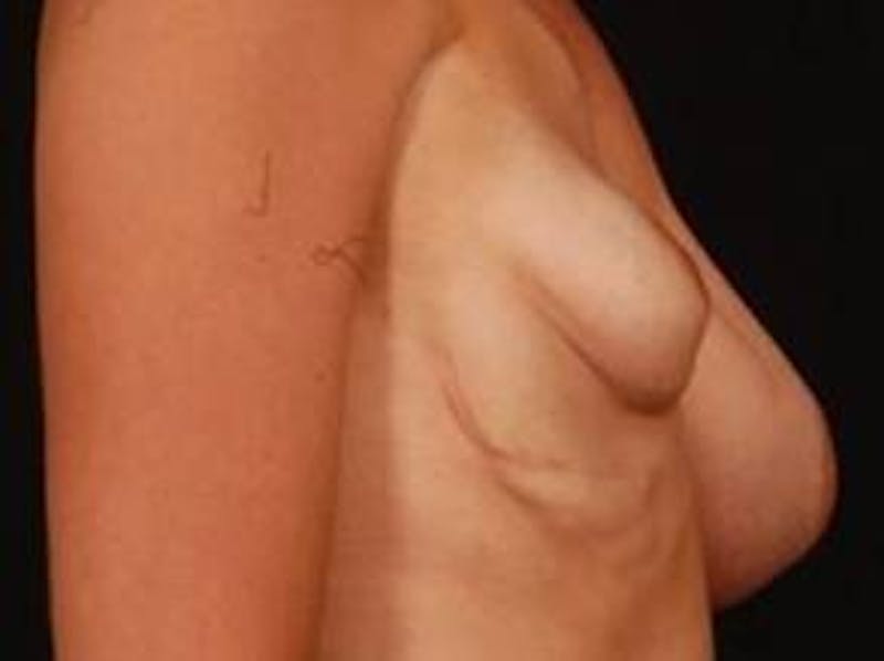 Breast Asymmetry Correction Before & After Gallery - Patient 399699 - Image 3