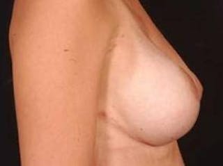 Breast Asymmetry Correction Before & After Gallery - Patient 399699 - Image 4