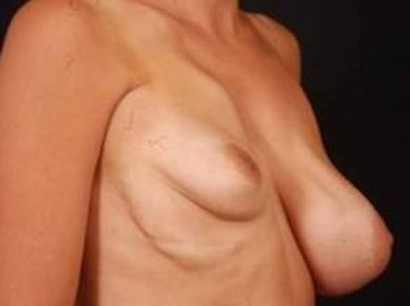 Breast Asymmetry Correction Before & After Gallery - Patient 399699 - Image 5