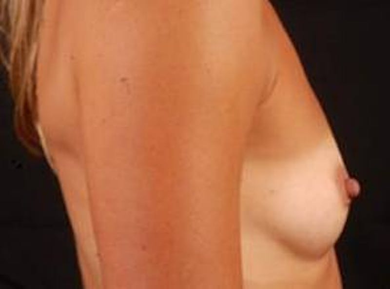 Breast Augmentation 410 Before & After Gallery - Patient 151017 - Image 5