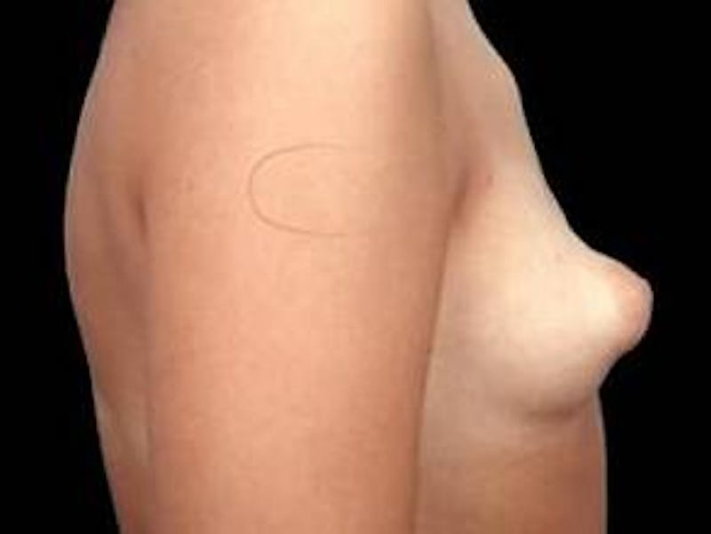 Breast Asymmetry Correction Before & After Gallery - Patient 100486 - Image 3