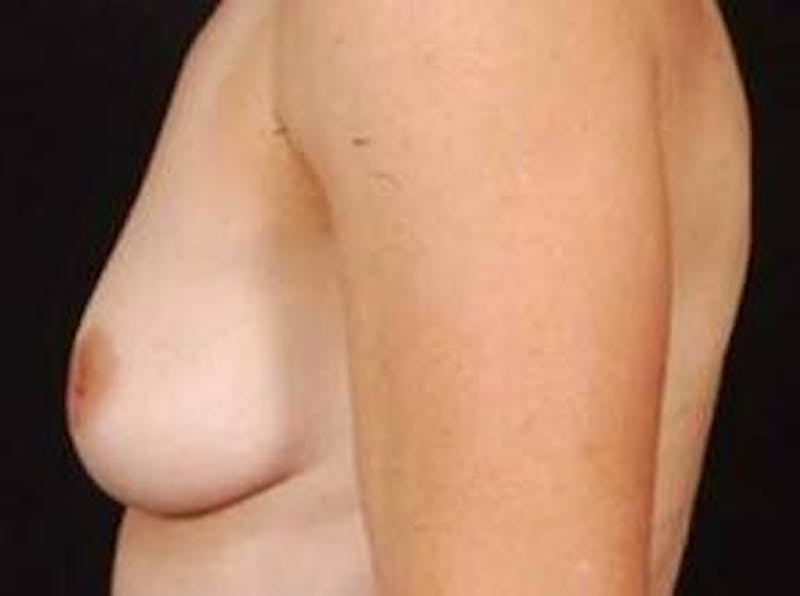 Breast Augmentation 410 Before & After Gallery - Patient 342084 - Image 3